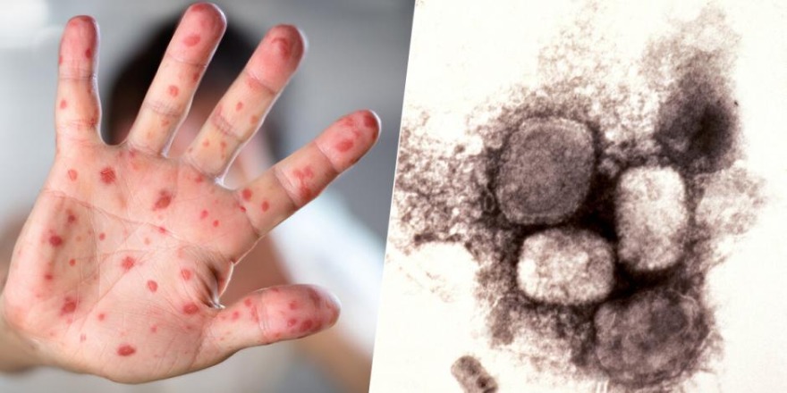 Por: Cortesía Secretaría de Salud estatal rechaza casos de viruela símica en Puebla