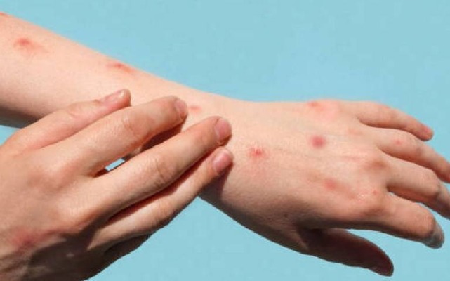 Por: Cortesía Confirma Secretaría de Salud dos casos de viruela del mono en Puebla