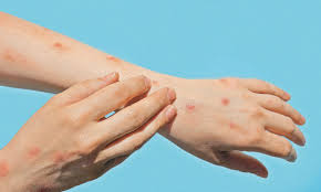 Por: Cortesía Registran caso de viruela símica en Tamaulipas