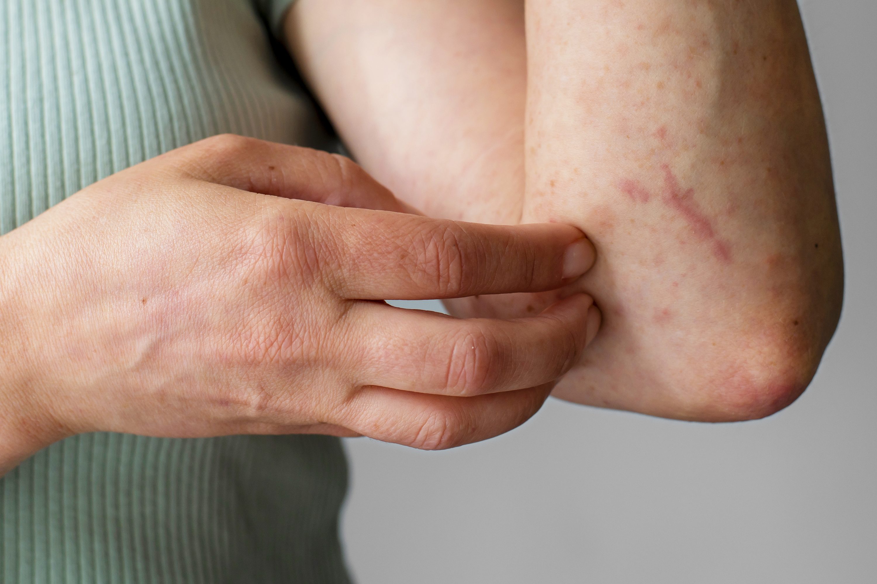 Por: Cortesía Dengue Puebla