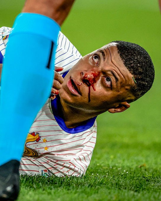 Por: Cortesía Kylian Mbappé sufre fractura de la nariz