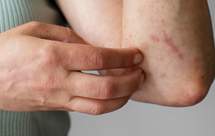 Por: Cortesía Dengue en Puebla: más de 4,399 casos y zonas endémicas en alerta