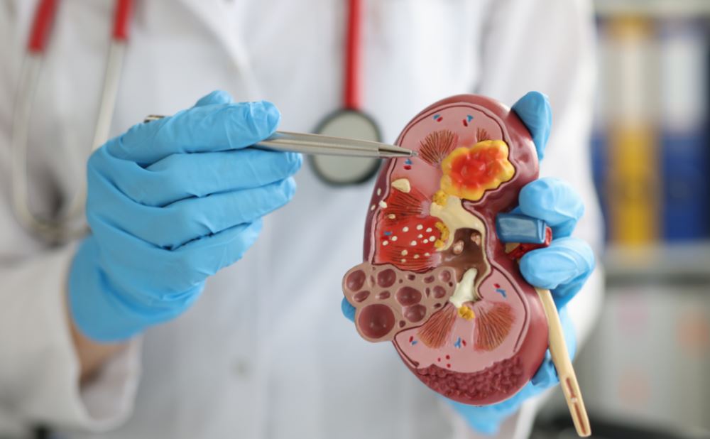 Por: Cortesía Cálculos renales: causas, síntomas y remedios naturales para combatirlos