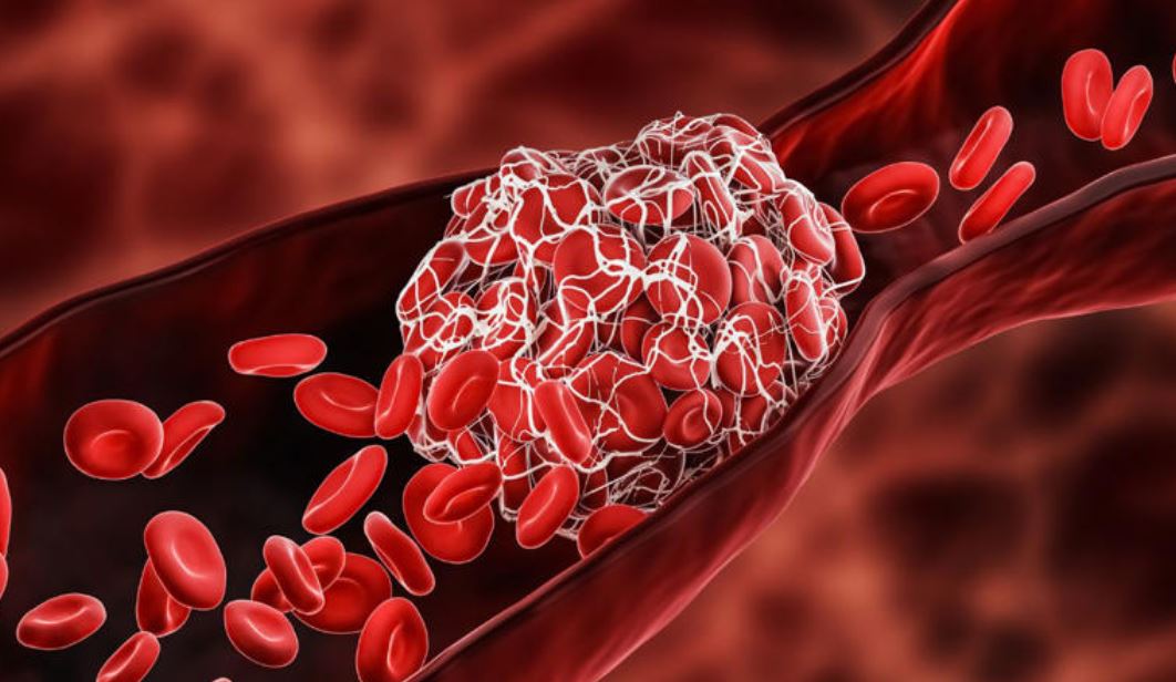 Por: Cortesía Dolor de cabeza severo: ¿Podría ser un infarto cerebral maligno? Conoce los signos