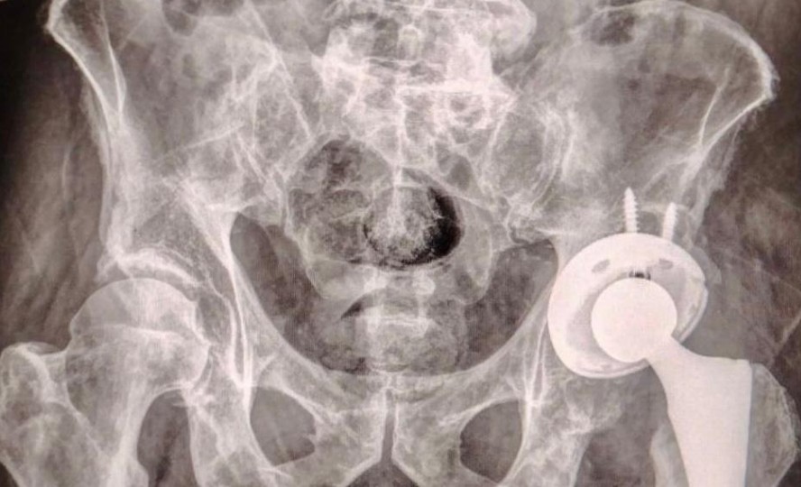 Foto: Cortesía Primera prótesis de cadera gratuita en el ISSSTEP: un avance en salud pública