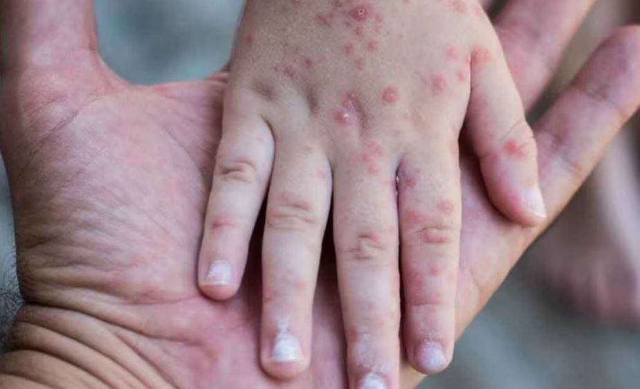 Foto: Cortesía México en alerta: aumentan casos de sarampión en 2025