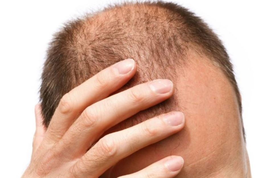 Foto: Cortesía ¿Cuándo es preocupante la caída del cabello en los hombres?