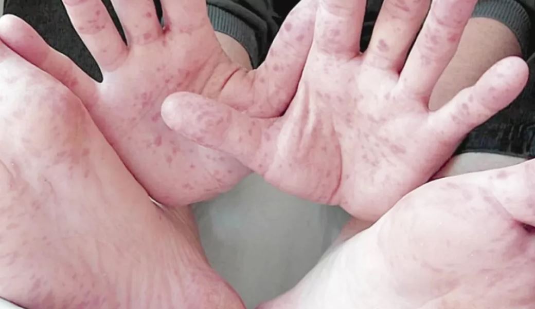 Foto: Cortesía Confirman 14 casos de virus Coxsackie en San Martín Texmelucan