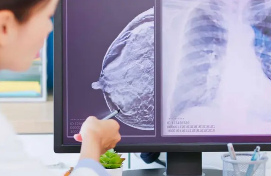 El cáncer en México: una realidad que no se puede ignorar