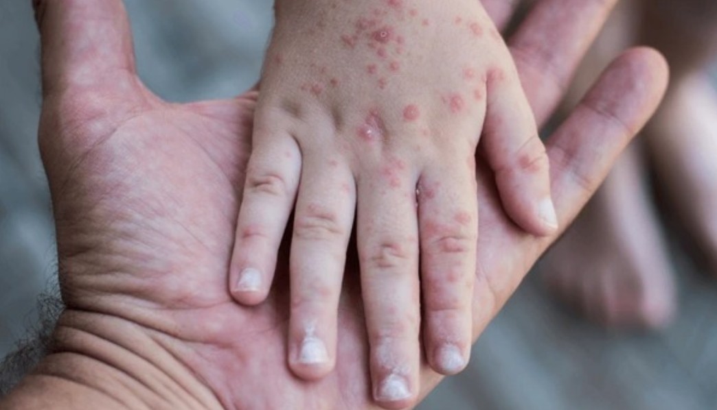 Gobierno refuerza vigilancia sanitaria por brotes de Coxsackie