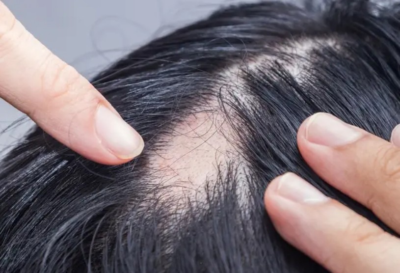 ¿Qué es la alopecia?