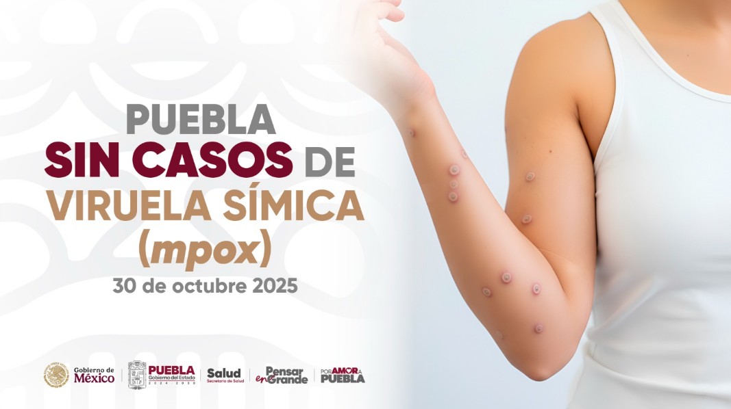 Aclaran rumores sobre viruela del mono en Puebla