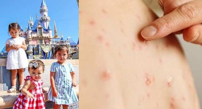 Foto: Cortesía La otra epidemia: ya son 150 casos de sarampión en México