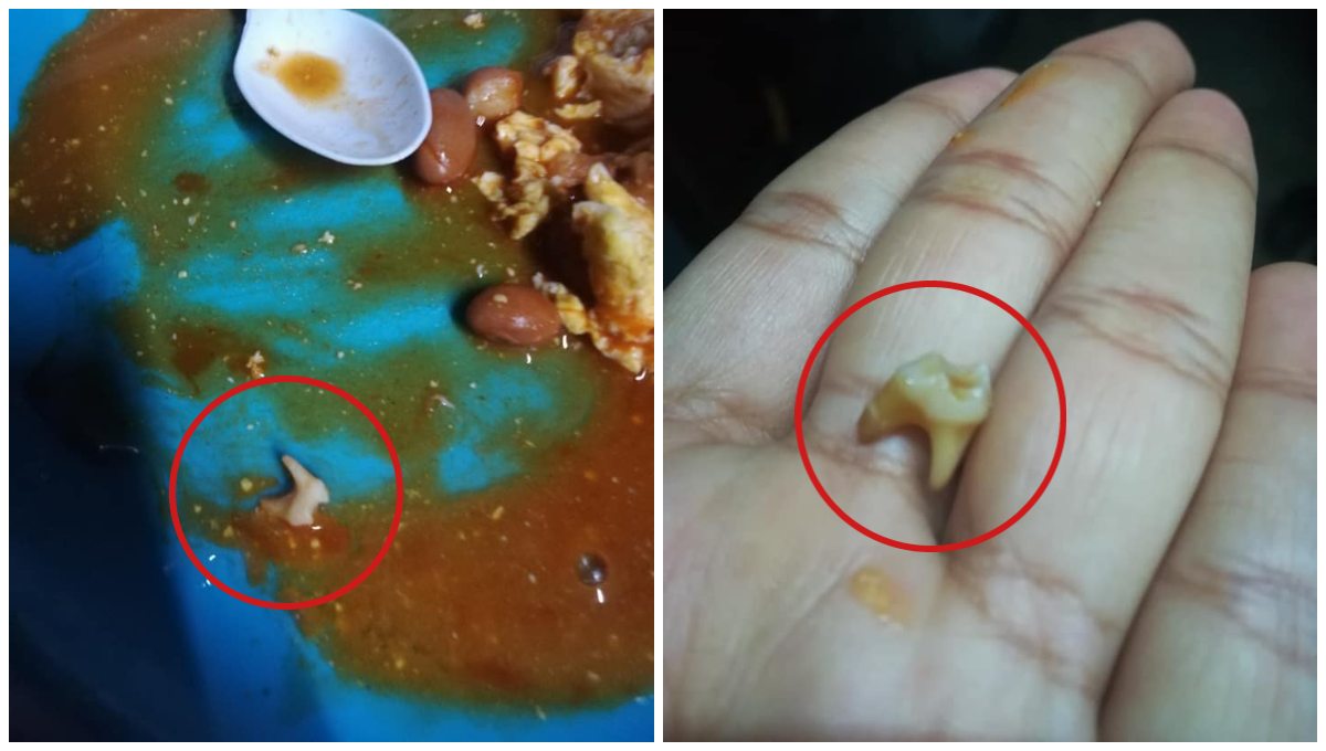 Foto: Cortesía ¿Será una piedrita?: Mujer encuentra muela humana en una lata de frijoles