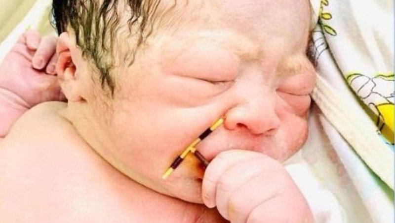 Foto: Cortesía La vida siempre encuentra la forma: Bebé nace con el DIU de su madre en la mano
