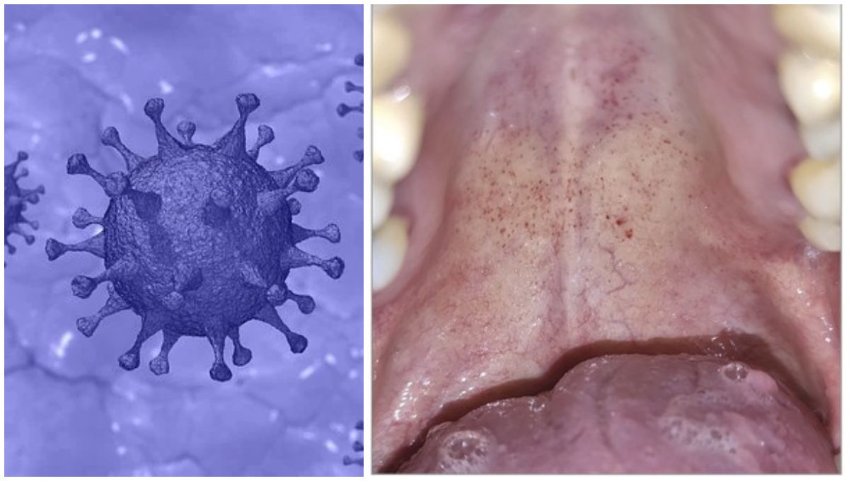 Foto: Cortesía Estudio muestra que los enantemas bucales podrían ser un nuevo síntoma de COVID-19