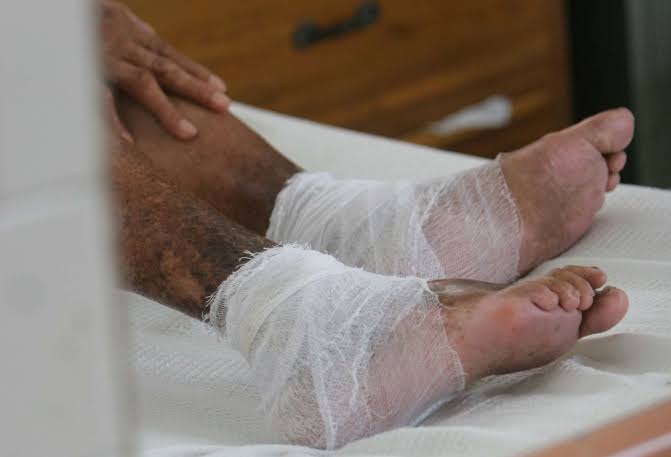 Foto: Cortesía Tlaxcala libre de casos de lepra