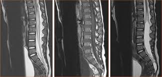 Foto: Cortesía ¿Qué es la mielitis transversa que se detectó en el voluntario de AstraZeneca?