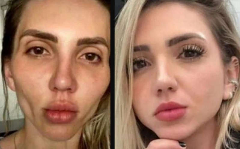 Por: Cortesía "Mi cara se cayó": influencer se arrepiente de hacerse la bichectomía; caso viral