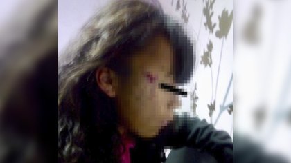 Hombre intenta abusar de niña de 11 años, al forcejear le marcó el rostro de por vida