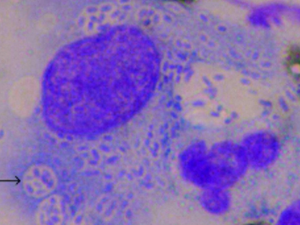 Por: Cortesía Médicos advierten de nueva enfermedad de transmisión sexual 'carnívora'