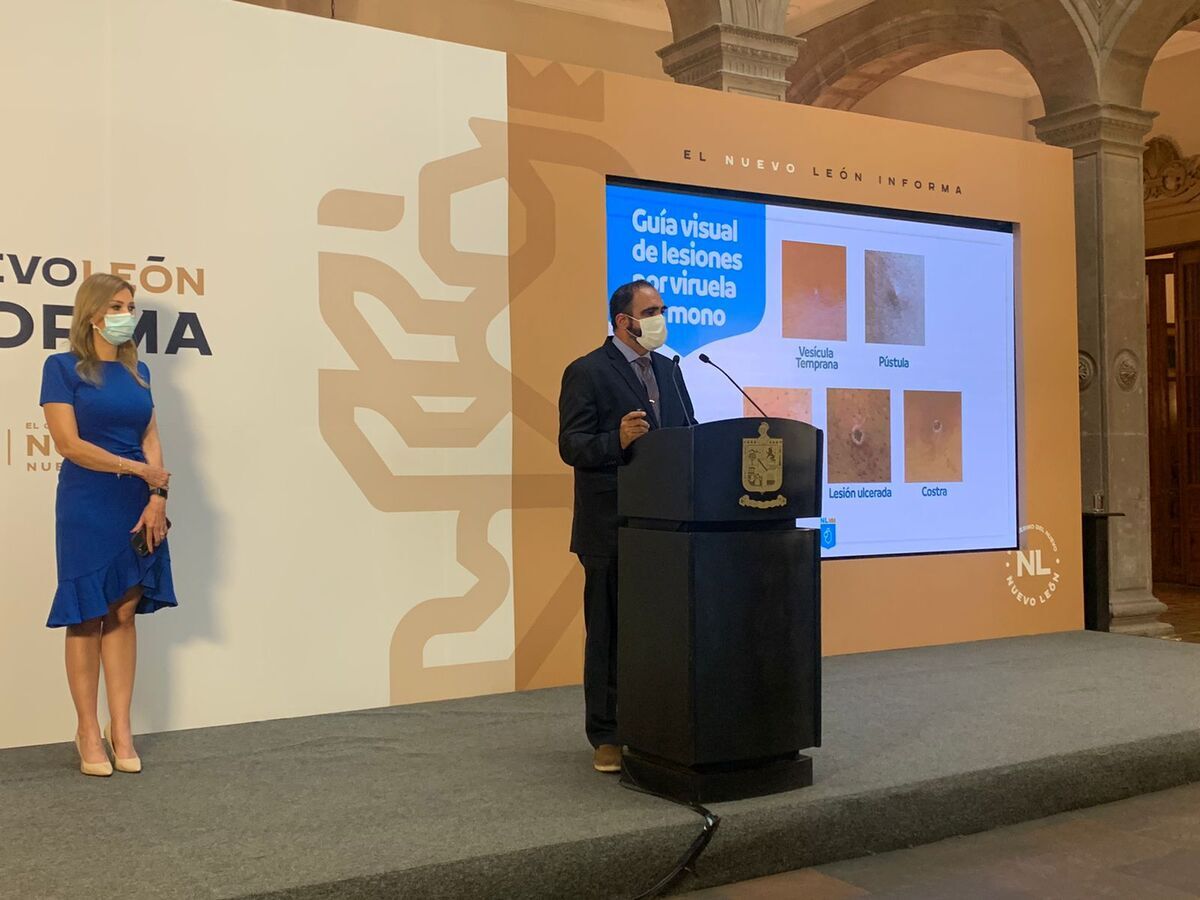 Por: Cortesía Confirman otro caso de viruela símica en NL, siendo el cuarto estado en el país con más casos