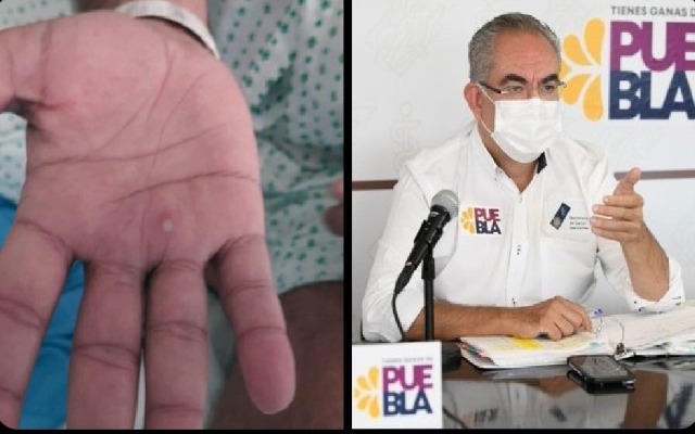 Por: Cortesía Secretaría de Salud reporta tres nuevos casos sospechosos de la viruela símica en Puebla