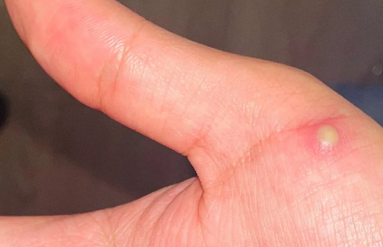 México reportó 134 nuevos casos de viruela símica para un total de 386