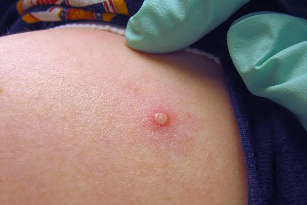 En regreso a clases deben mantenerse protocolos sanitarios ante la Viruela Símica: Académica 