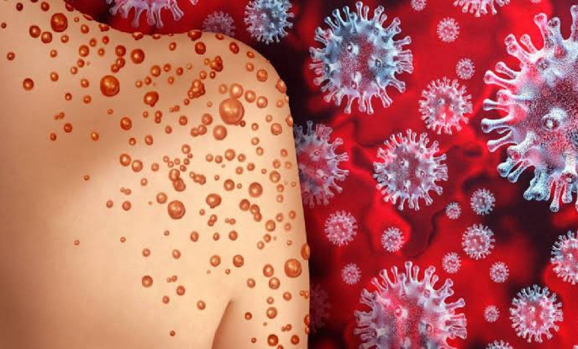 Por: Cortesía Cumple Tlaxcala un mes sin contagios de viruela símica