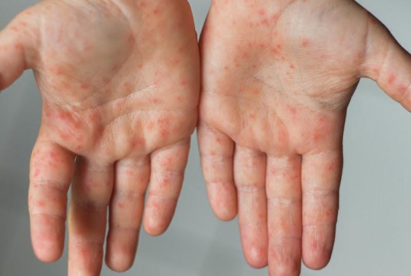 Tlaxcala libre de casos por viruela símica