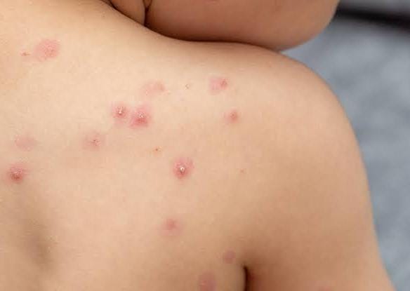 Por: Cortesía Periodo vacacional aumenta riesgo de aparición de viruela símica en Tlaxcala