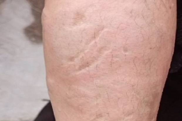 Por: Cortesía Dos hombres atacan con ácido a una mujer tras salir del SAT Angelópolis