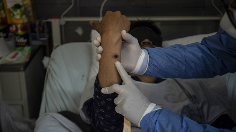 Por: Cortesía México ha registrado 4 muertes por viruela del mono hasta ahora; van más de 3 mil contagios