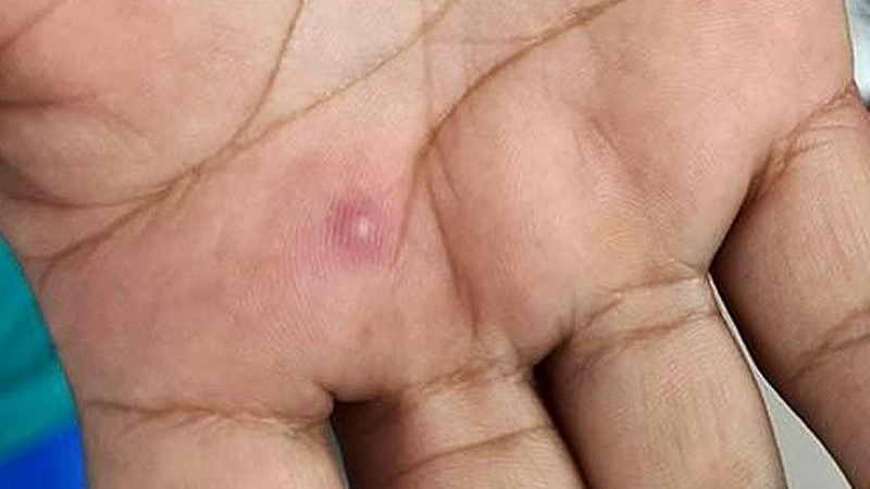 Por: Cortesía Investiga Jalisco su primera muerte asociada a viruela del mono