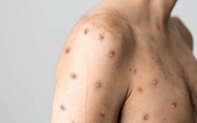 Confirman desde el gobierno federal 33 casos de viruela símica en Puebla