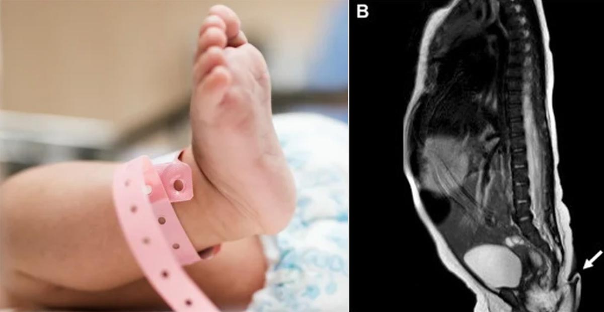 Por: Cortesía Nace bebé con cola de casi 6 centímetros de largo en Nuevo León