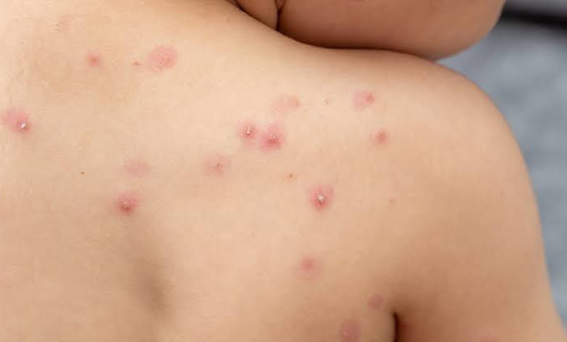 Ascienden a 5 los casos confirmados de viruela símica en Tlaxcala
