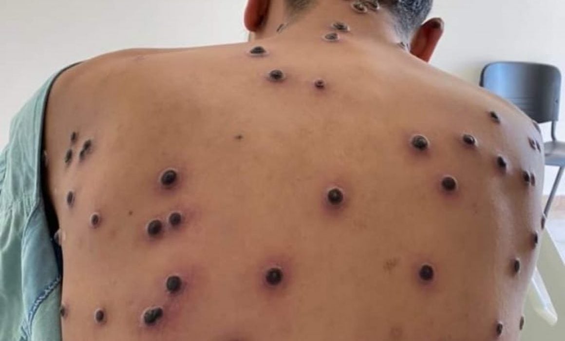 Se suman 2 casos de viruela símica en Tlaxcala