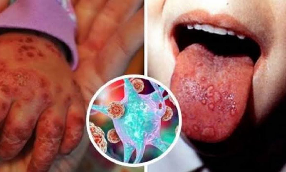 Confirman brote del virus coxsackie en primaria de Tlaxcala