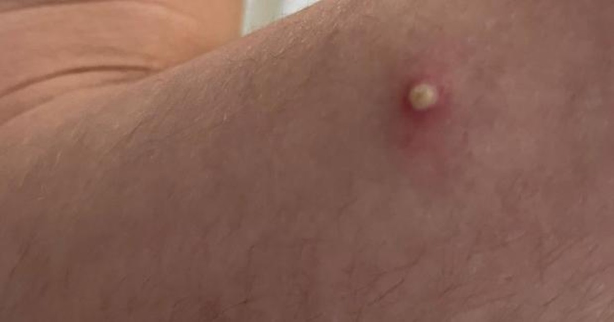 papula viruela mono kFEG 1200x630abc