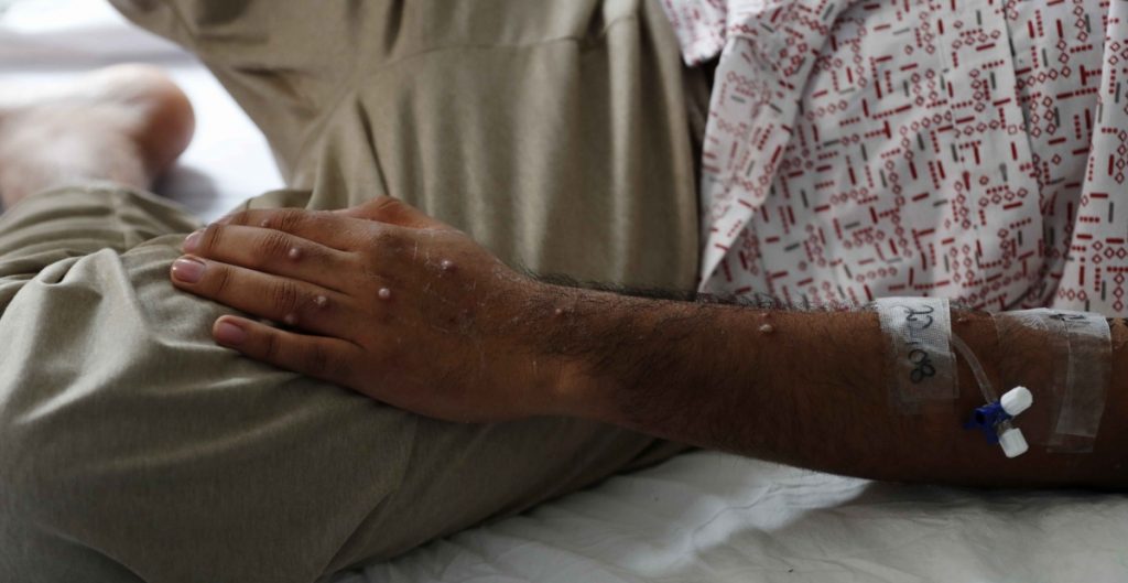 Confirman en Los Ángeles, EEUU, primera muerte a causa de viruela símica