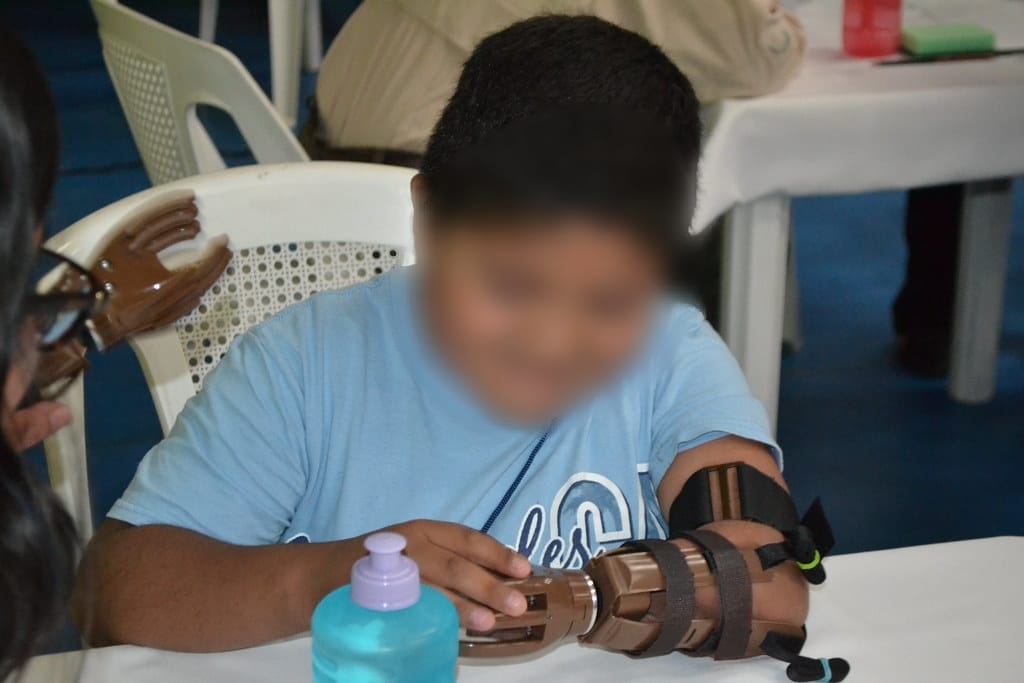 Apoya Secretaría De Bienestar campaña para prótesis de mano gratuita del Club Rotario