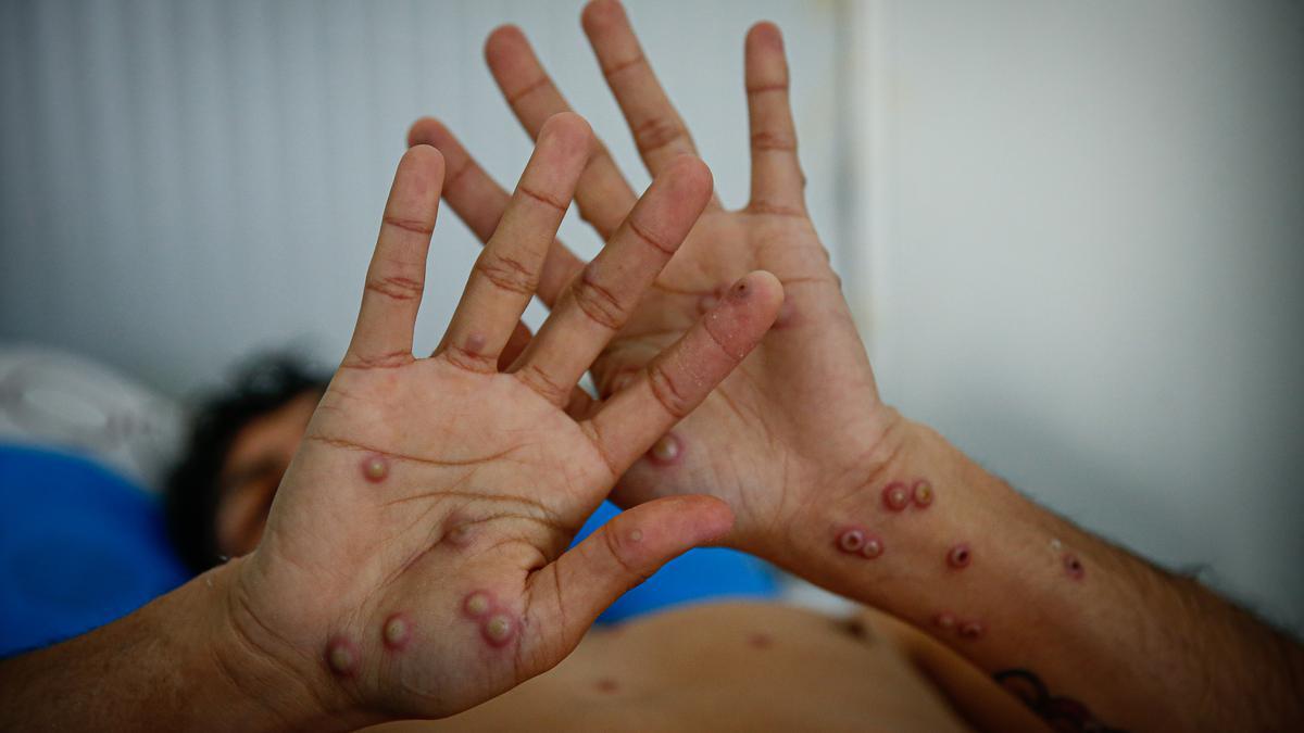 Por: Cortesía Confirma Chiapas 4 casos más de viruela símica, hasta ahora se han acumulado 14 contagios