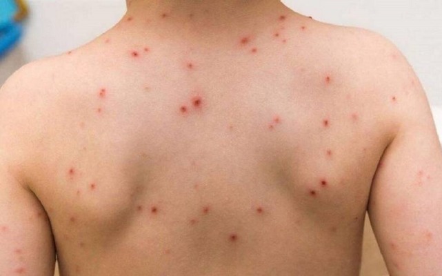 Por: Cortesía Puebla no registró casos de viruela símica en primer trimestre de 2023