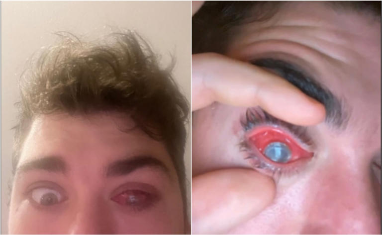 Por: Cortesía Joven olvida quitarse lentes de contacto para dormir y casi pierde un ojo; incidente se hace viral (Vídeo)