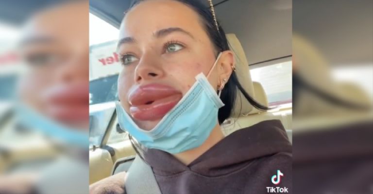 Por: Cortesía Mujer queda desfigurada tras someterse a tratamiento  con ácido hialurónico (Vídeo)